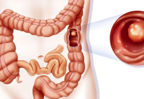 Tổng quan về ung thư trực tràng